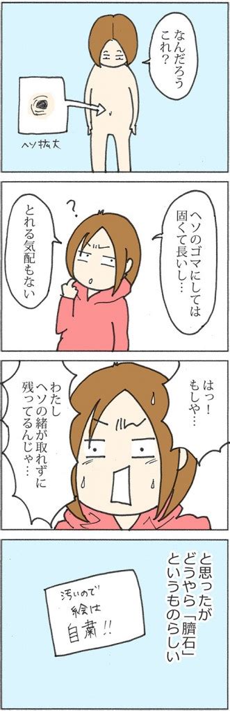 臍石除去|47話「妊婦になって初めてわかった臍石」 – かたく。